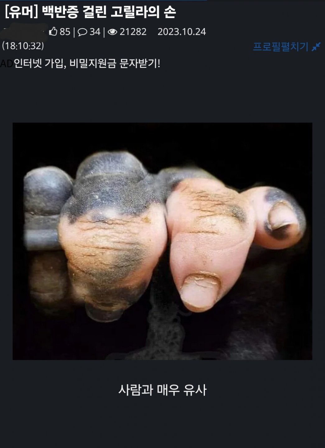 백반증에 걸린 고릴라의 손