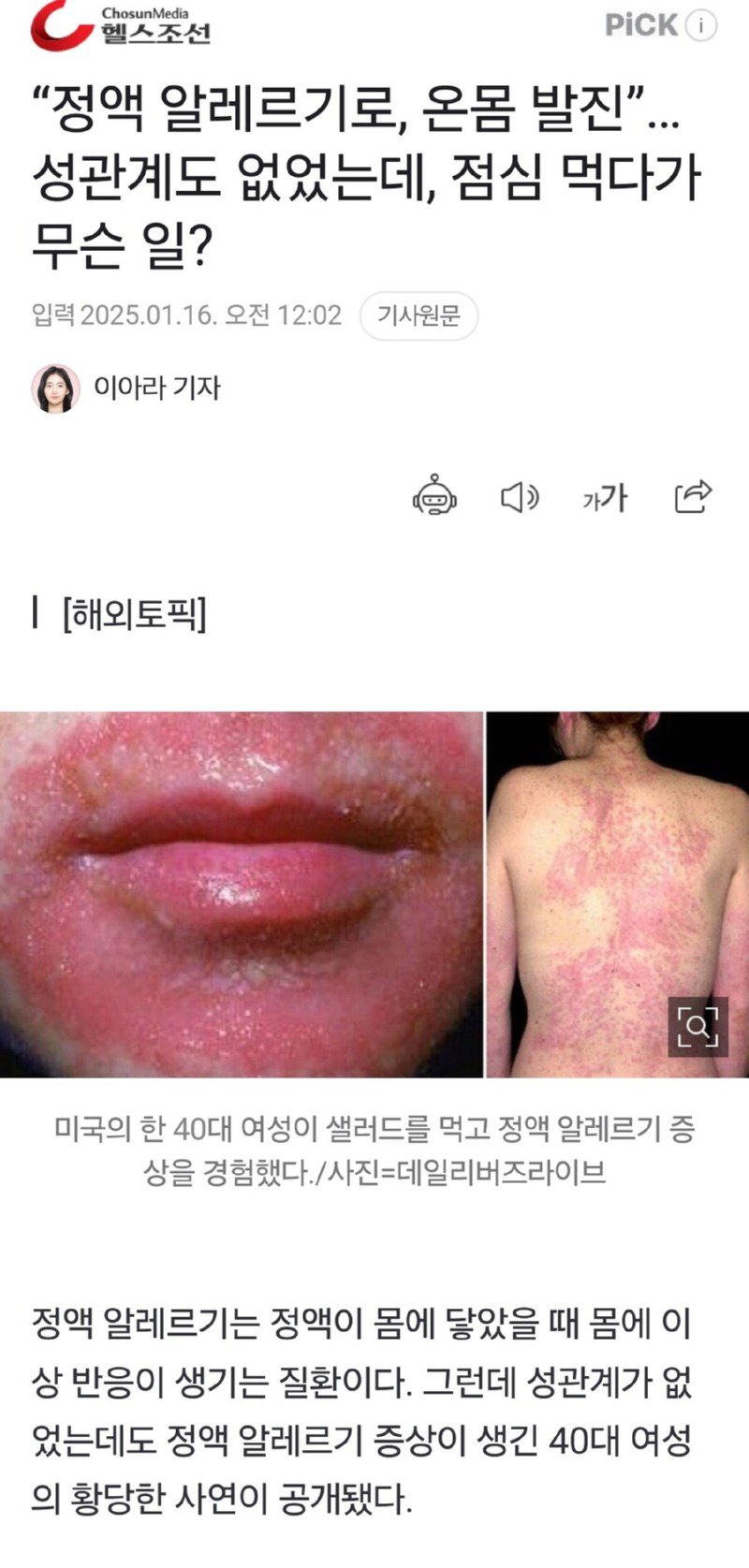 약혐) 직장에서 샐러드를 먹다 알러지가 나타난 여성