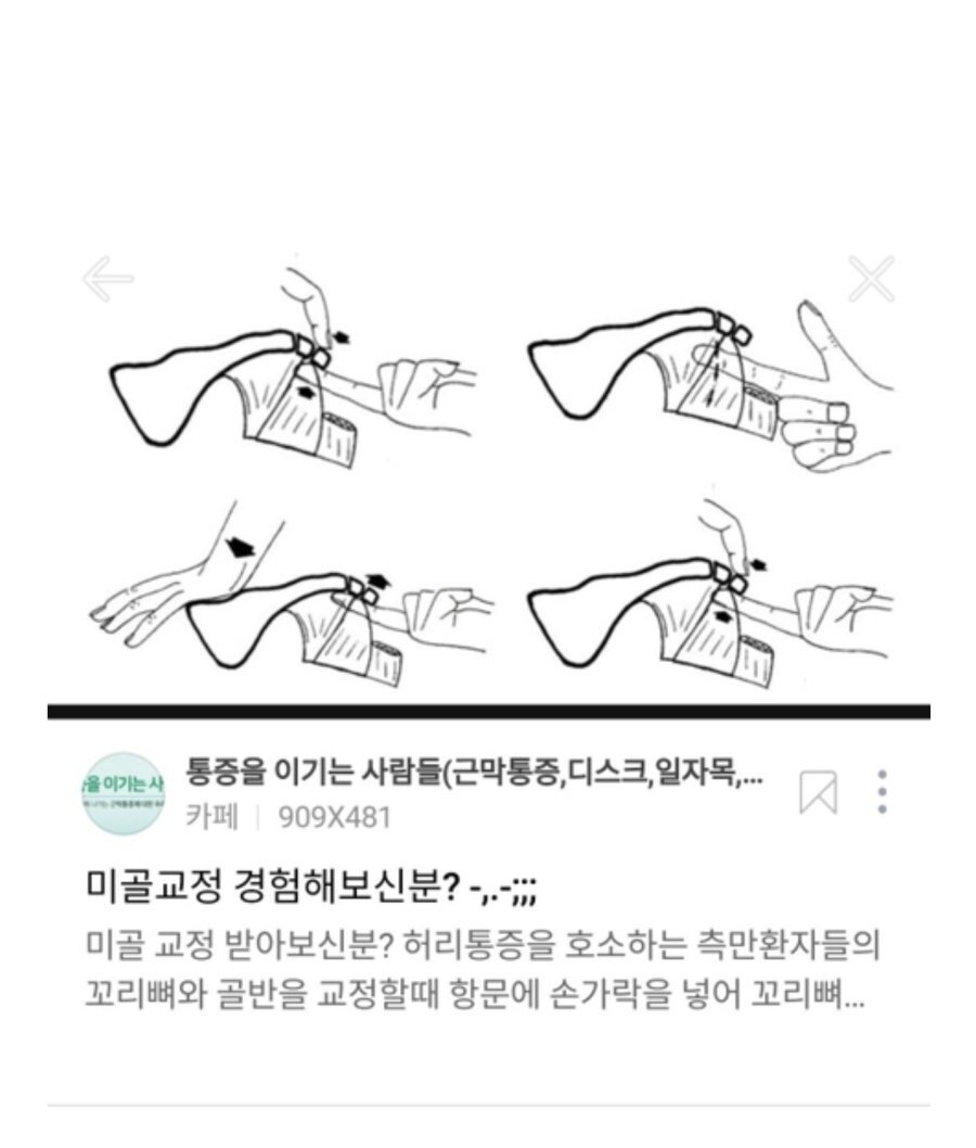 항문에 직접손을 넣어 척추교정하는 미골교정.